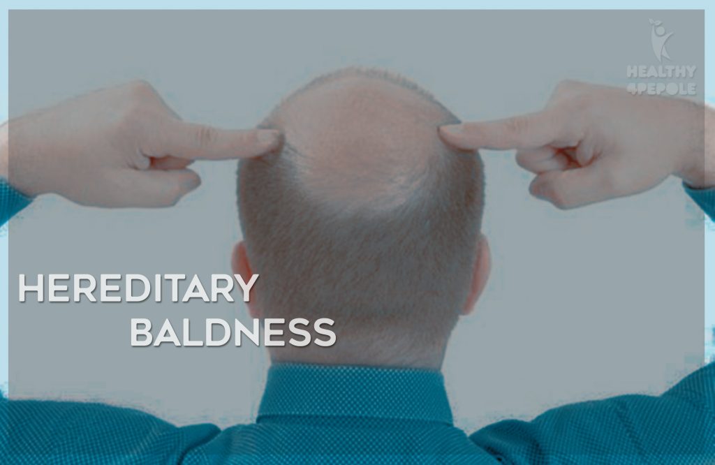 Hereditary Baldness